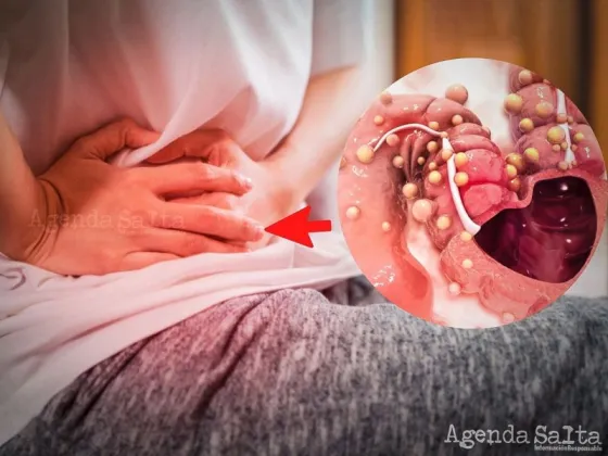 Cáncer de colon: alerta por el aumento de casos en menores de 50 años