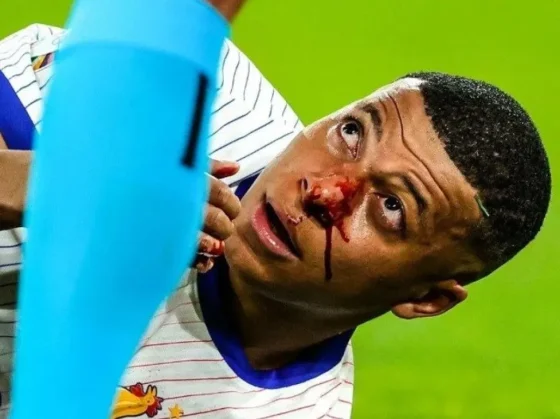 Kylian Mbappé se fracturó en medio de un partido y podría perderse el resto de la Eurocopa