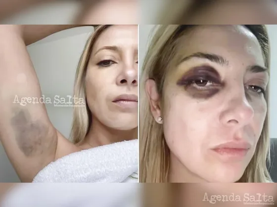 Las fotos de Fabiola Yañez con golpes en la cara y el cuerpo