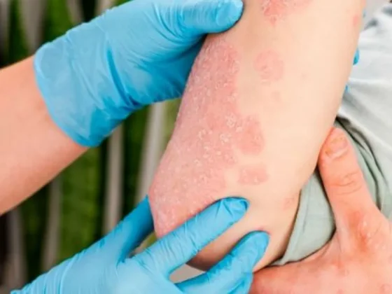 El 81% de las personas que acudieron a la detección de psoriasis dieron resultado positivo